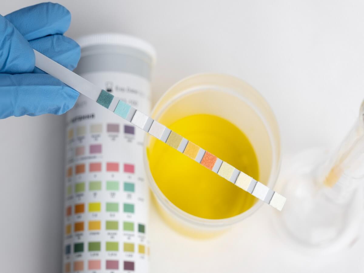 Glucose in Urine Purpose, Test Procedure, and Results