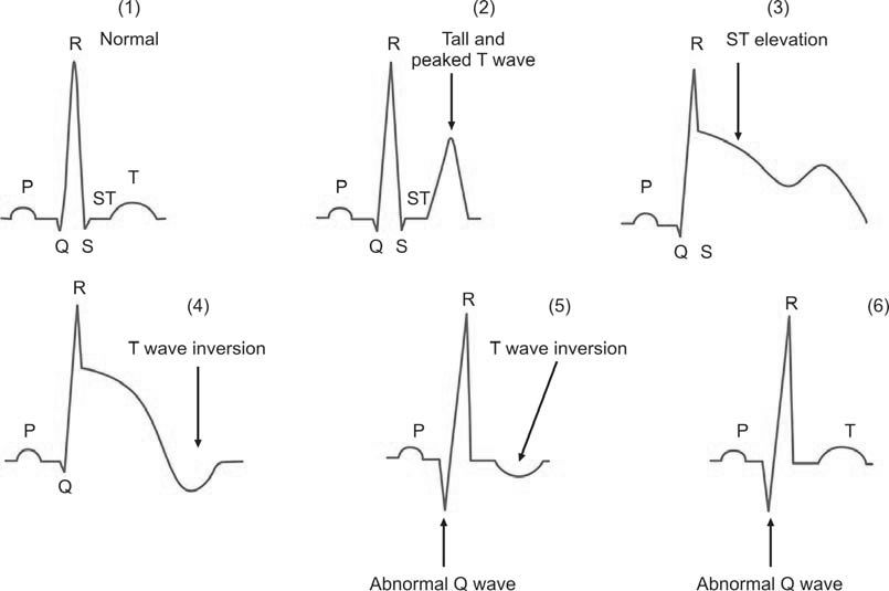 Sequential electrocardiographic changes after acute myocardial infarction