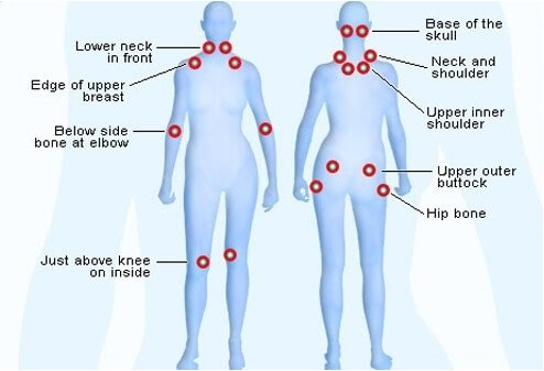 Tender points on the body are one hallmark of Fibromyalgia