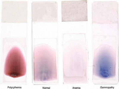 Peripheral Blood Smear